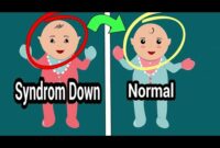 Ciri-Ciri Bayi Down Sindrome